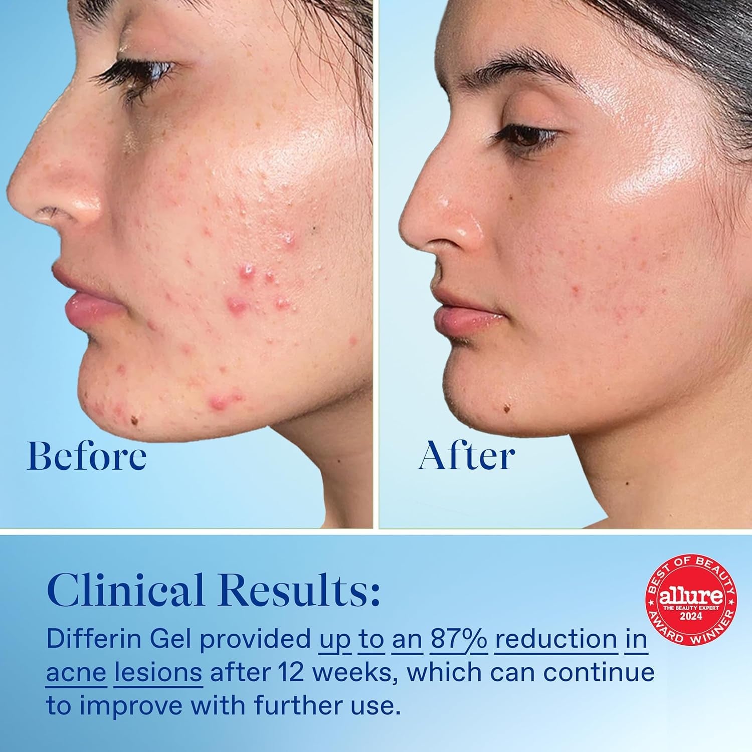 Acne Treatment Gel, 30 Day Supply, Retinoid Treatment for Face with 0.1% Adapalene, Gentle Skin Care for Acne Prone Sensitive Skin, 15G Pump (Packaging May Vary)
